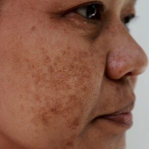 Hyperpigmentation